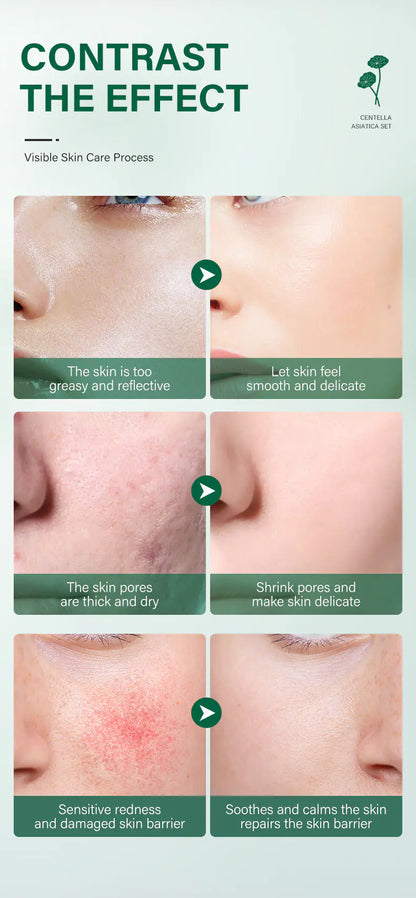Private Label Skin Repair Centella Skin Care Kit Soothes Acne Face Care Centella Asiatica Extract Natural Facial Skin Care Set